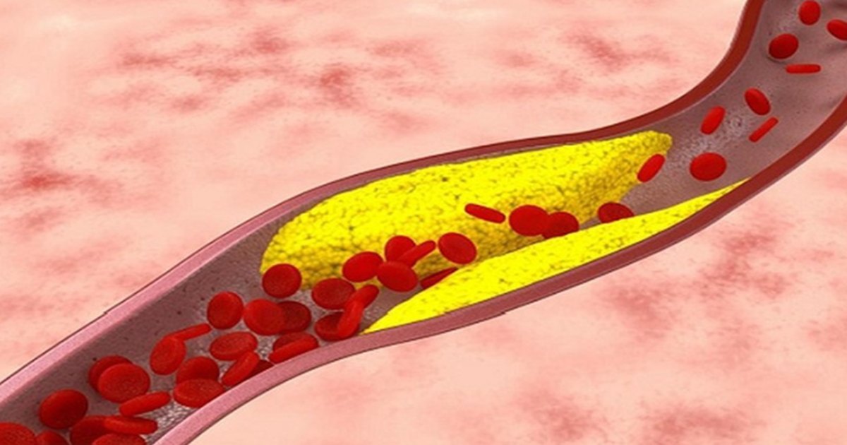 Xơ vữa động mạch là gì? Nguyên nhân thật sự nhiều người bỏ qua