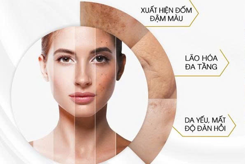 Dấu hiệu cơ bản giúp nhận biết nám da do nội tiết (Ảnh: Sưu tầm internet)