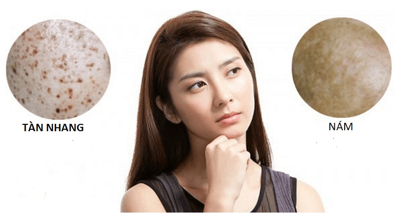 Nám da là các mảng sẫm màu, bờ mờ, thường liên quan rối loạn nội tiết. Tàn nhang là đốm nhỏ, bờ rõ, chủ yếu do di truyền và ánh nắng (Nguồn: Internet)