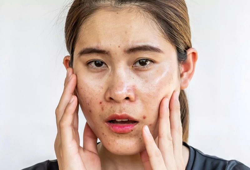 Da bóng nhờn và tiết mồ hôi - Dấu hiệu gan thải độc qua da (Ảnh: Sưu tầm internet)