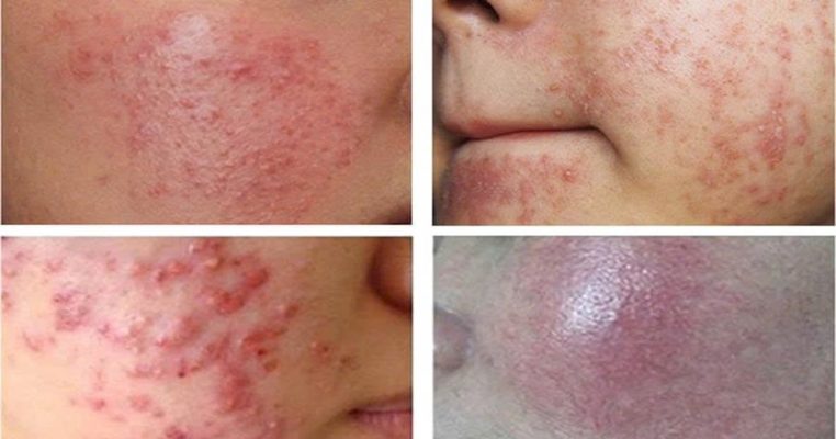 Dấu hiệu thải độc qua da - Khi làn da đang “lên tiếng” thay cơ thể