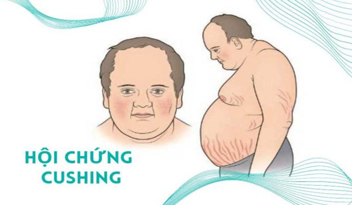 Hội chứng Cushing: Dư thừa cortisol và những biến chứng nguy hiểm