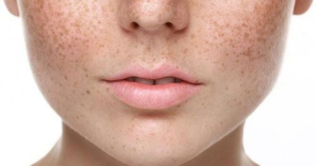 Nám da do đâu? Bị nám da có chữa được không?