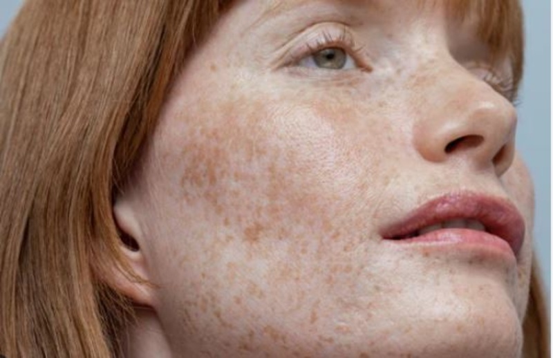 Nám da biểu hiện bằng các mảng da sẫm màu do melanin tăng sinh quá mức (Nguồn: Internet)