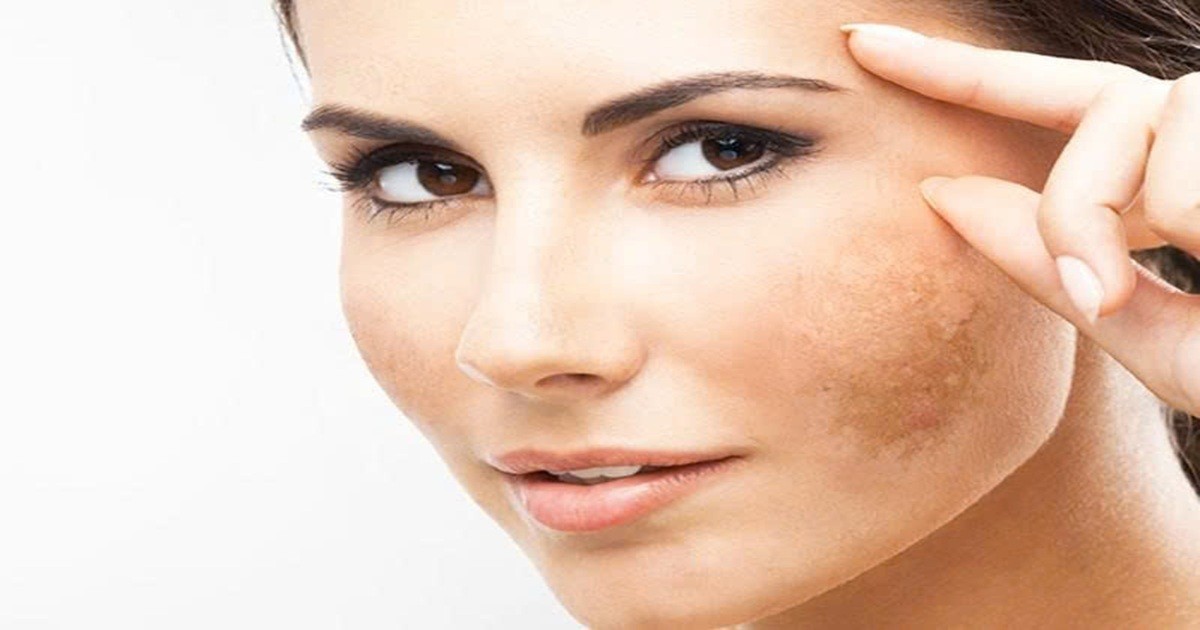 Nguyên nhân gây nám nội tiết ở phụ nữ: Không chỉ do hormone