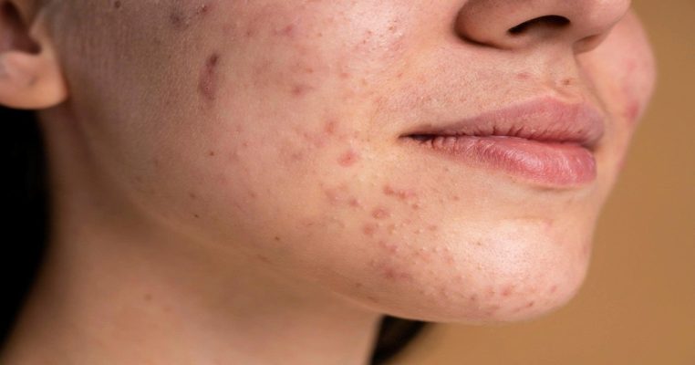 Nguyên nhân mụn mọc quanh miệng và cằm bạn nên biết