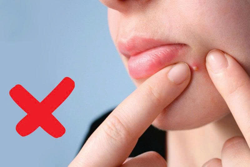 Tránh nặn mụn vì dễ dẫn đến viêm nặng hơn (Ảnh: Sưu tầm internet)