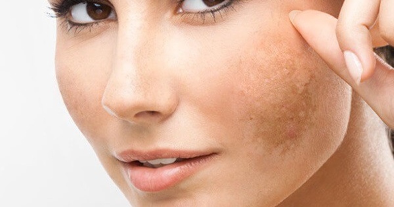 Rối loạn estrogen khiến da dễ xuất hiện nám và lão hóa nhanh hơn, vì hormone này quyết định độ ẩm, đàn hồi và sắc hồng tự nhiên của làn da (Nguồn: Internet)