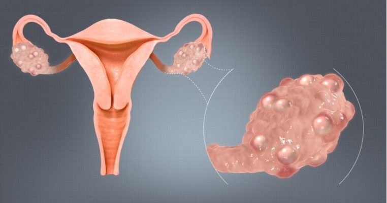 Rối loạn phóng noãn là gì? Hiểu đúng để không đánh mất cơ hội làm mẹ