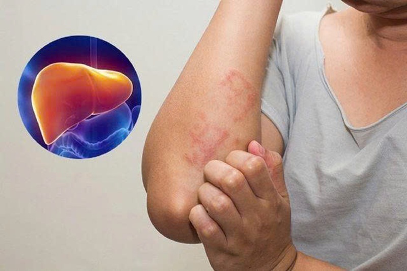 Gan thải độc qua da - Dấu hiệu cần thải độc cơ thể (Ảnh: Sưu tầm internet)