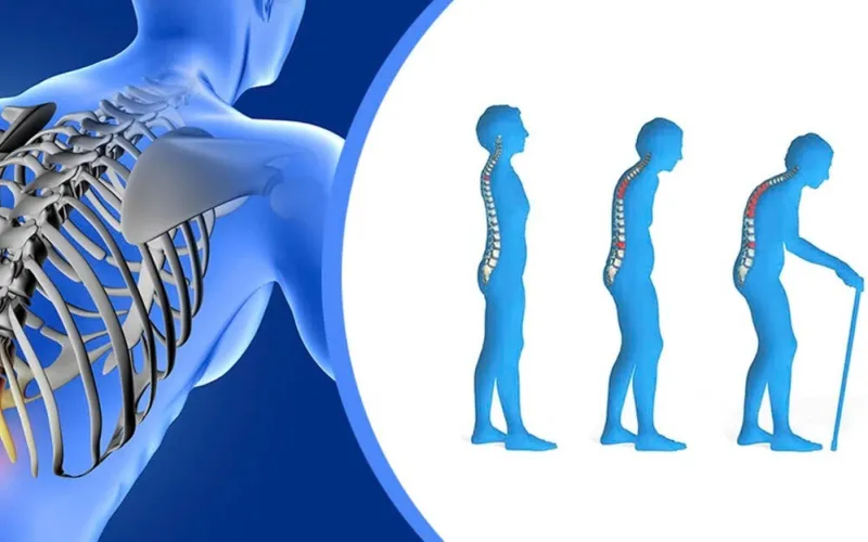 Nguyên nhân của bệnh loãng xương ở phụ nữ là sự kết hợp của nhiều yếu tố (Ảnh: sưu tầm Internet)