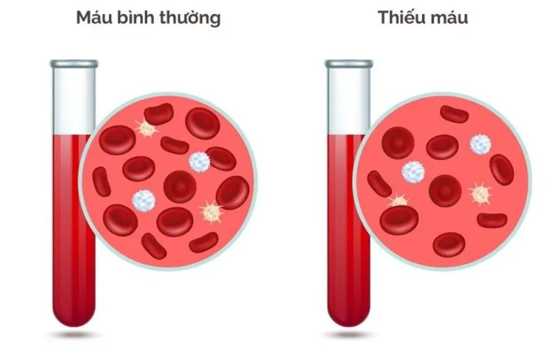 Axit folic hỗ trợ cơ thể sản xuất hồng cầu khỏe mạnh, giúp phòng ngừa thiếu máu do thiếu hụt folate (Nguồn: Internet)