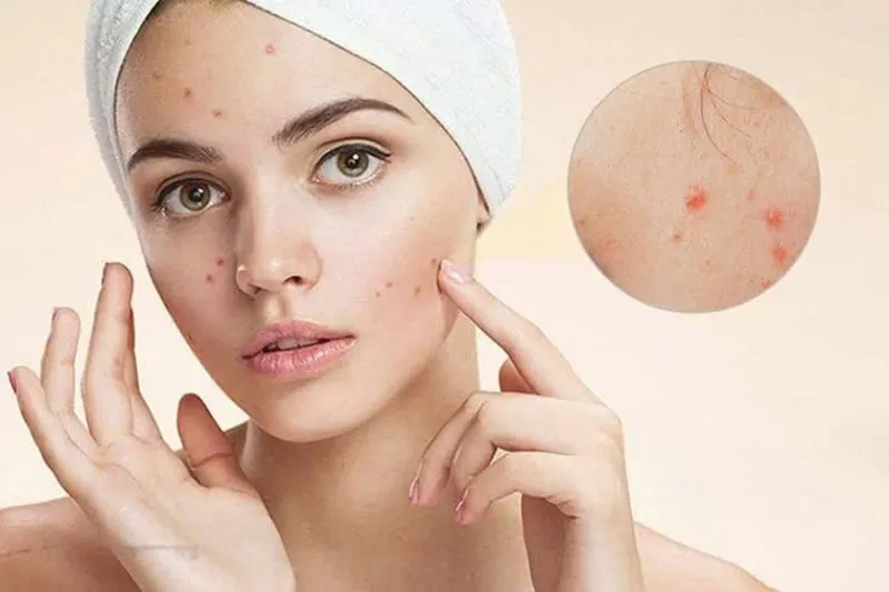 Ăn phô mai có thể làm tăng mụn và viêm da ở người da dầu hoặc da nhạy cảm (Ảnh: Sưu tầm Internet)