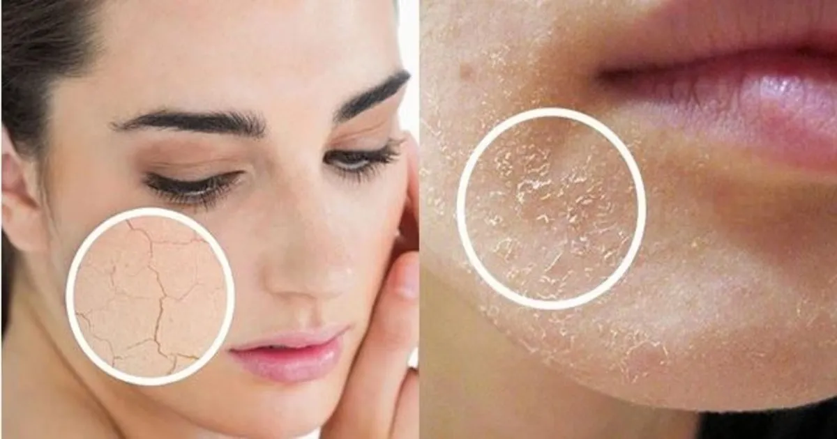 Da khô ráp sần sùi: Cải thiện từ nội tiết giúp da mịn từ gốc