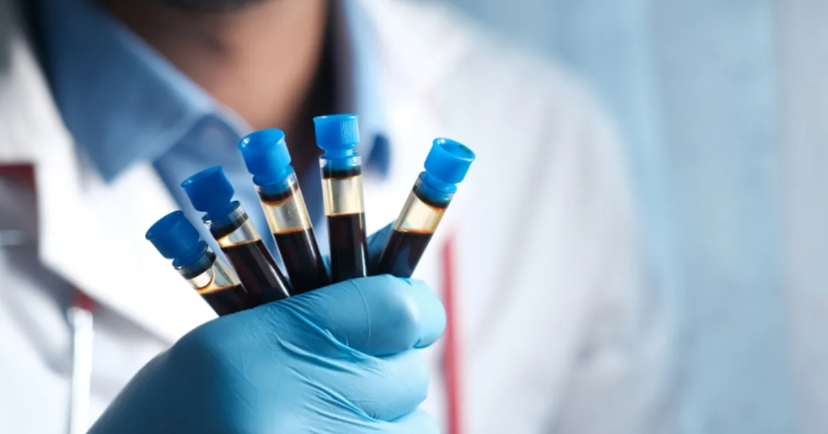 Xét nghiệm Progesterone: Vì sao nhiều phụ nữ cần kiểm tra?