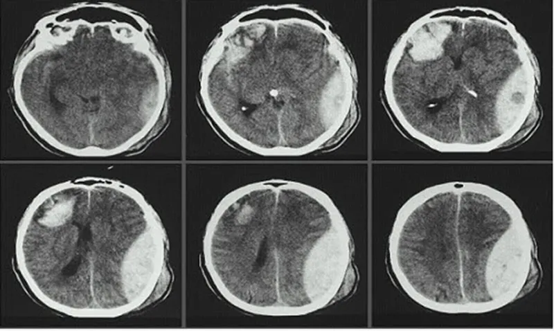 CT Scan sọ não giúp phát hiện các bất thường trong não (Ảnh: Sưu tầm Internet)
