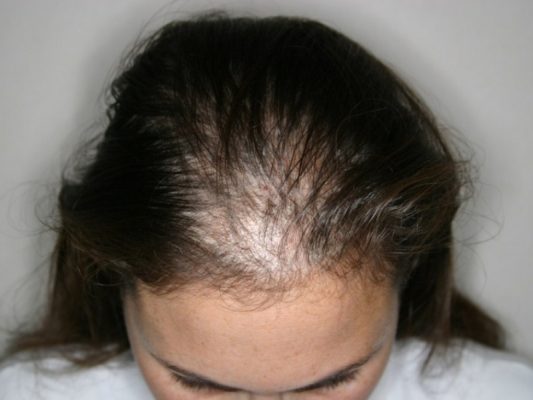 Tôi 41 tuổi, bị rụng tóc nhiều dù chưa có dấu hiệu tiền mãn kinh