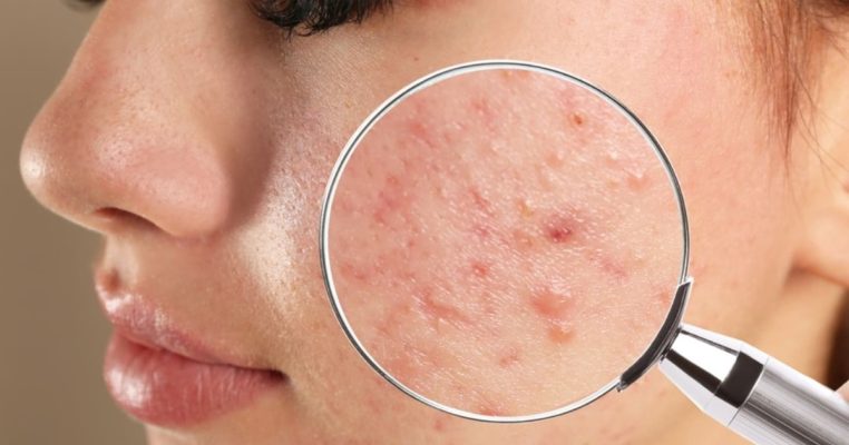 Cách phân biệt mụn nội tiết và phương pháp điều trị hiệu quả