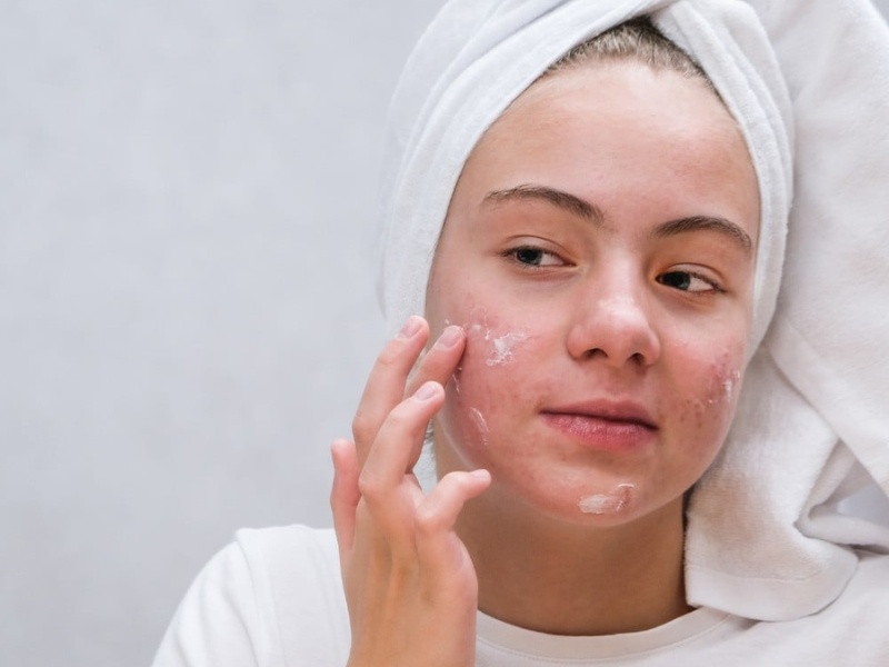Sử dụng chống nắng hằng ngày giúp hỗ trợ kiểm soát mụn nội tiết hiệu quả
