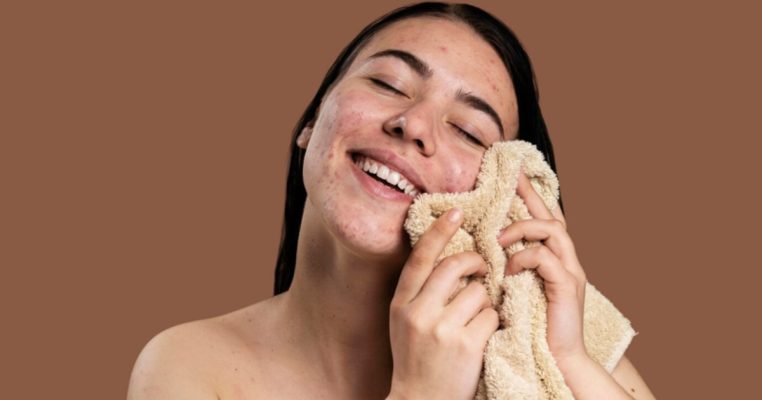 Điều trị mụn nội tiết ở nữ - Cách xử lý dứt điểm