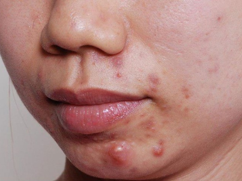Mụn nội tiết ở nữ thường tập trung ở vùng cằm và có tái phát theo chu kỳ kinh nguyệt