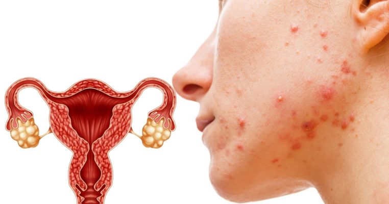 Mụn nội tiết quanh cằm là dấu hiệu buồng trứng có vấn đề