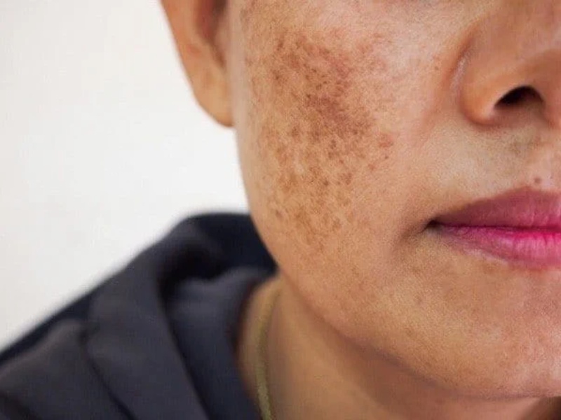 Nám chân sâu có màu nâu xám hoặc nâu xanh, thường xuất hiện ở gò má