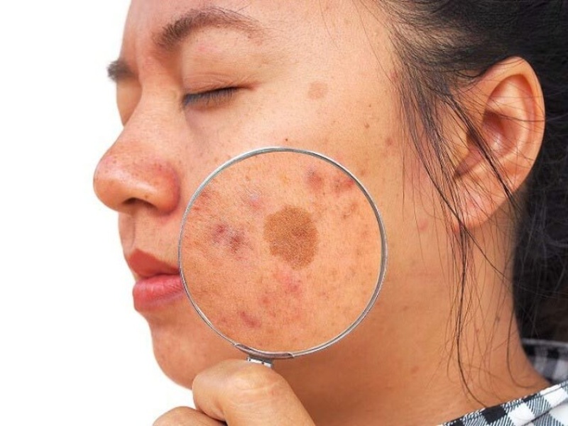 Nám chân sâu có thể tái xuất hiện nếu nguyên nhân nội tiết và stress oxy hóa chưa được kiểm soát