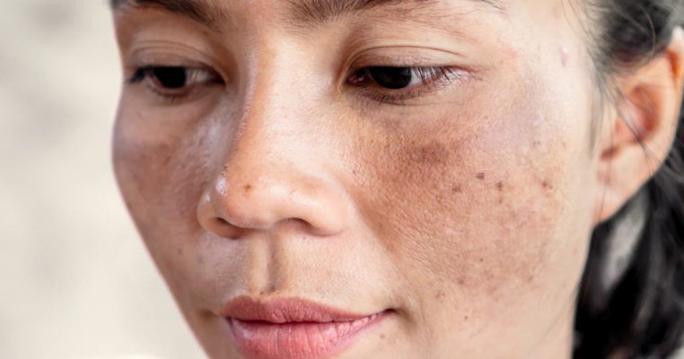 Nám chân sâu là gì? Nguyên nhân từ nội tiết tố và cách trị