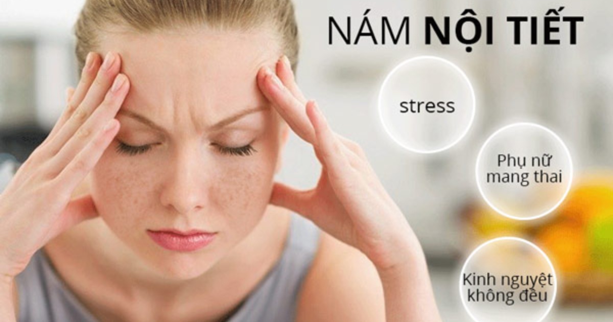 Nguyên nhân gây nám nội tiết và phương pháp điều trị