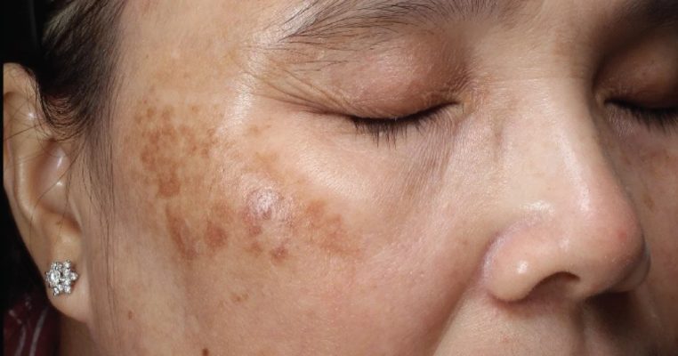 Trị nám nội tiết từ bên trong: Tiếp cận đúng gốc, giảm tái phát