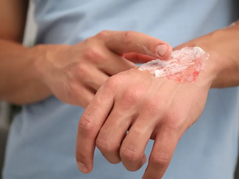 Giai đoạn tái tạo da bị thương có thể mất vài năm