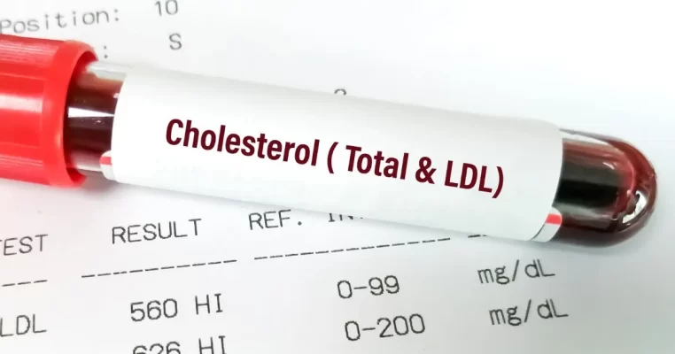 Ngưỡng cholesterol LDL tối ưu để giảm nguy cơ đột quỵ