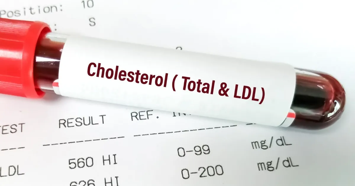 Ngưỡng cholesterol LDL tối ưu để giảm nguy cơ đột quỵ
