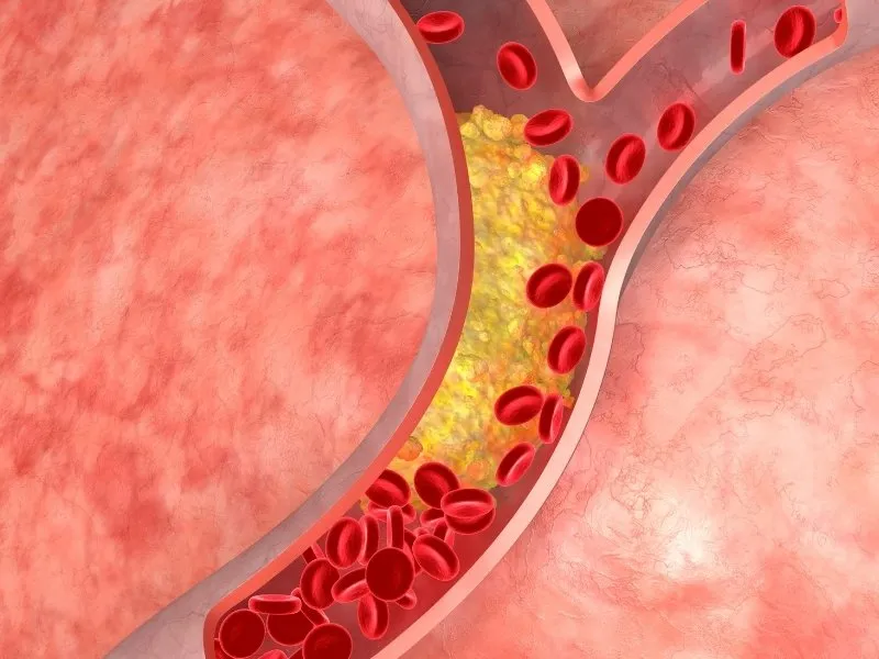 Triglyceride tăng cao làm dòng máu sẽ dễ dàng bị ứ trệ (Nguồn: Internet)